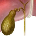 How to choose the treatment plan for gallstones? Medication or surgery